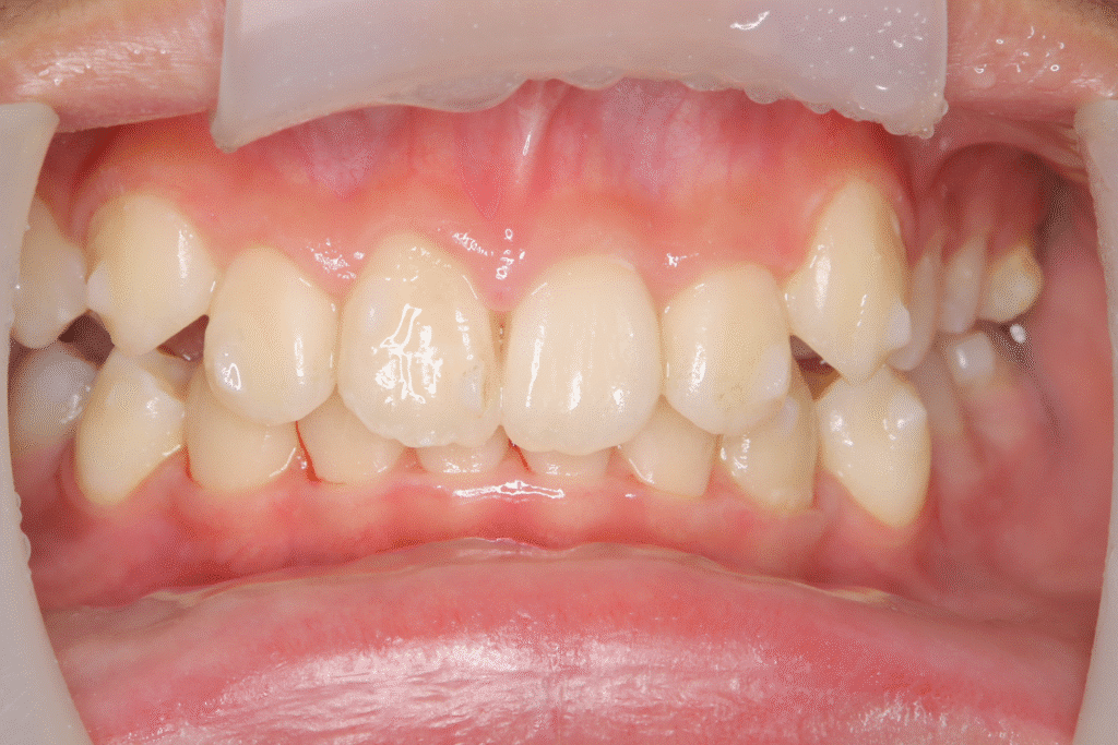 上顎前突(12歳2ヶ月)開始後18ヶ月
