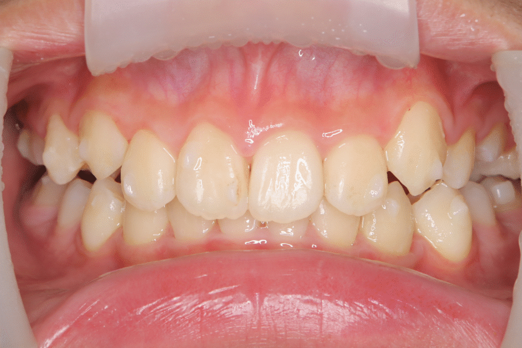 上顎前突(12歳4ヶ月)開始後20ヶ月