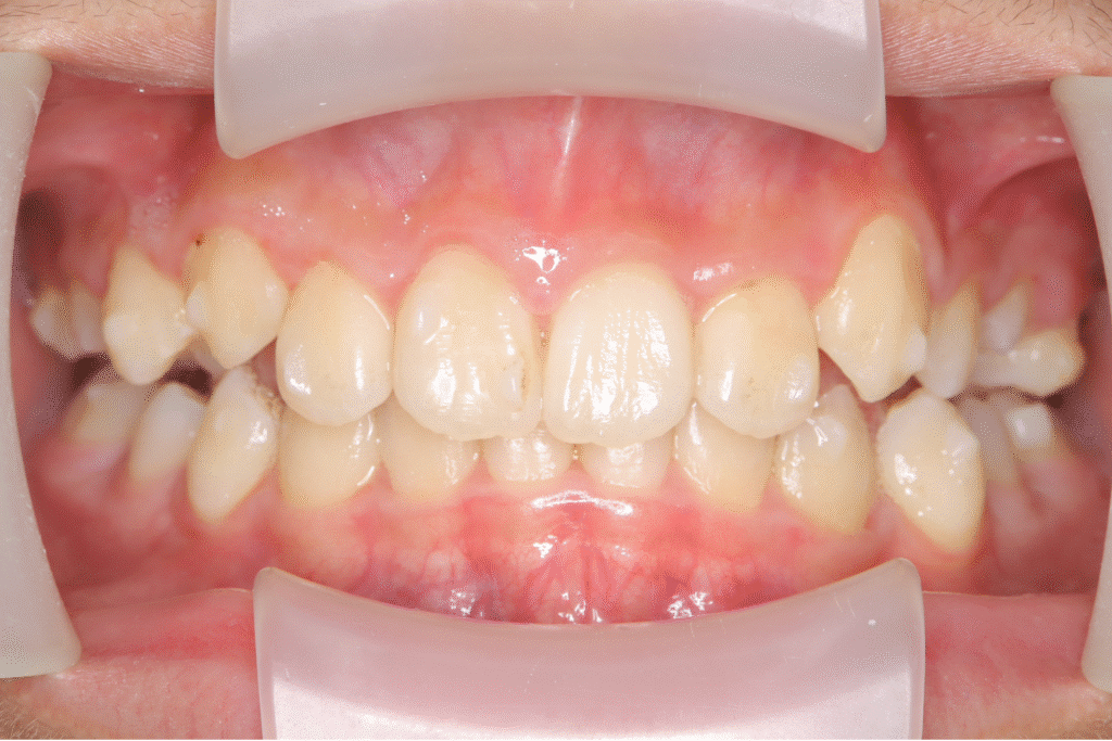 上顎前突(12歳5ヶ月)開始後21ヶ月