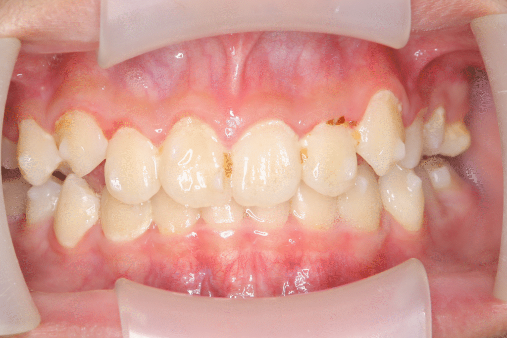 上顎前突(12歳7ヶ月)開始後23ヶ月