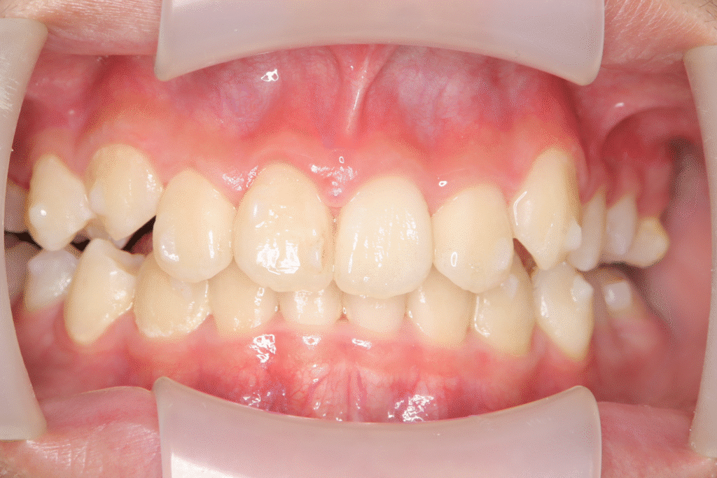 上顎前突(12歳8ヶ月)開始後24ヶ月