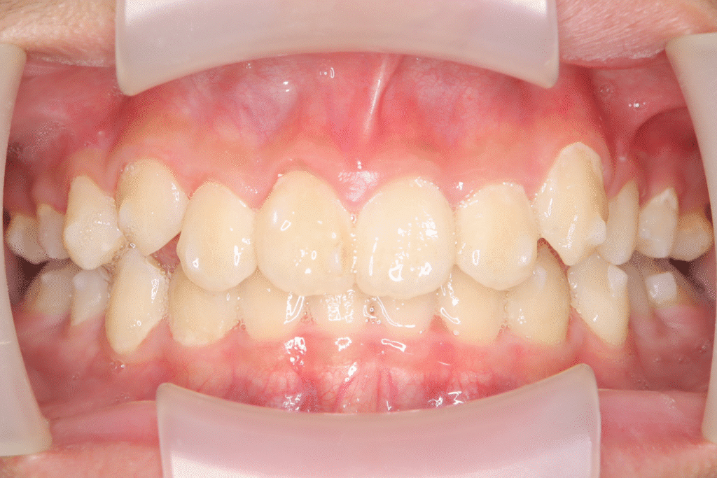 上顎前突(12歳9ヶ月)開始後26ヶ月