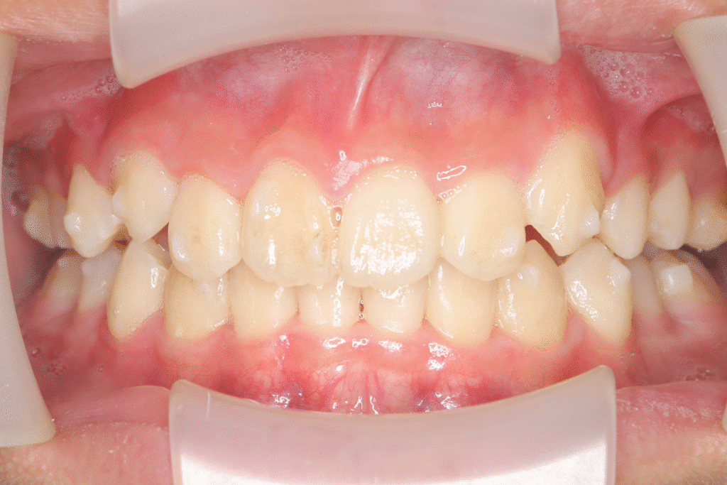 上顎前突(12歳11ヶ月)開始後27ヶ月