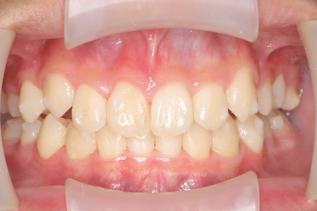 上顎前突(13歳1ヶ月)開始後29ヶ月