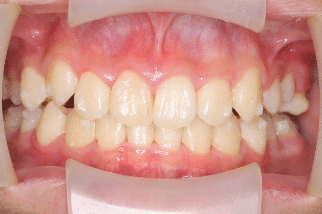 上顎前突(13歳2ヶ月)開始後31ヶ月
