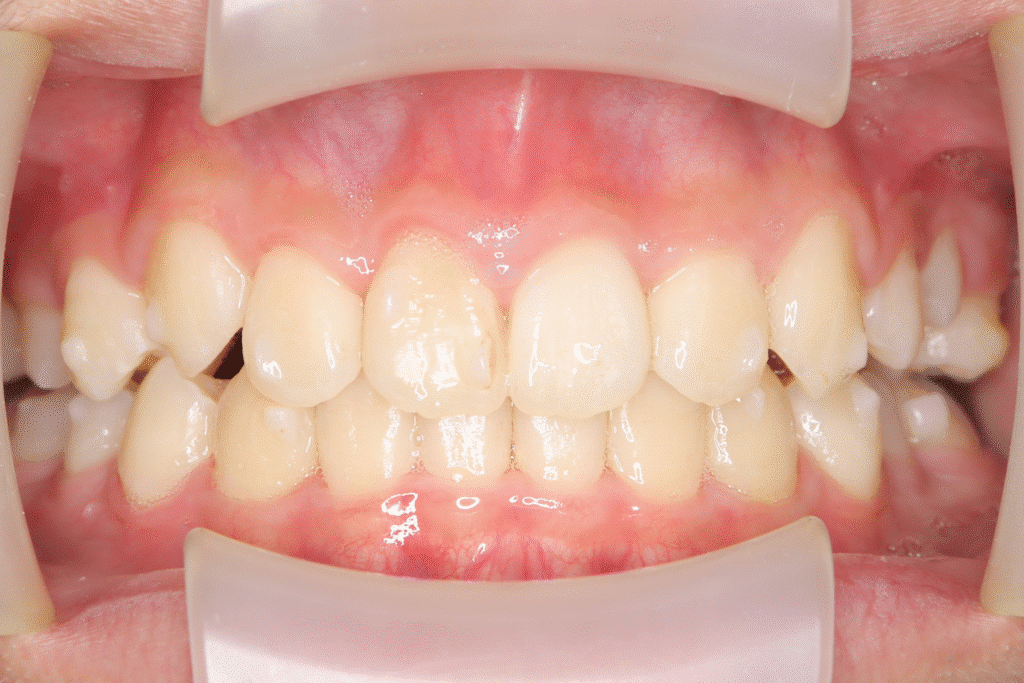 上顎前突(13歳3ヶ月)開始後33ヶ月