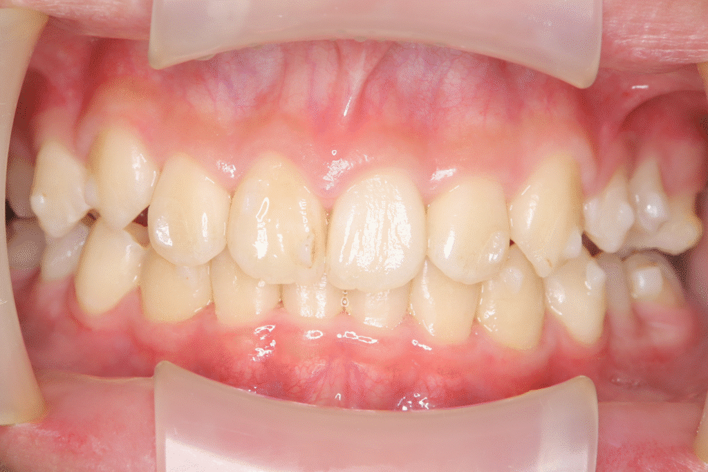 上顎前突(13歳5ヶ月)開始後35ヶ月