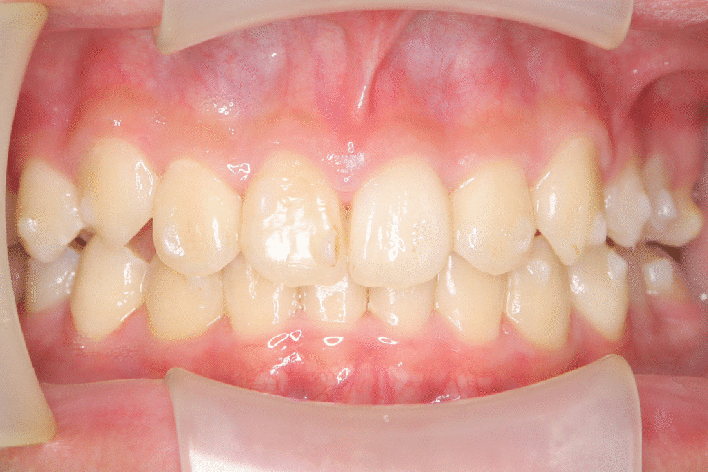 上顎前突(13歳7ヶ月)開始後36ヶ月