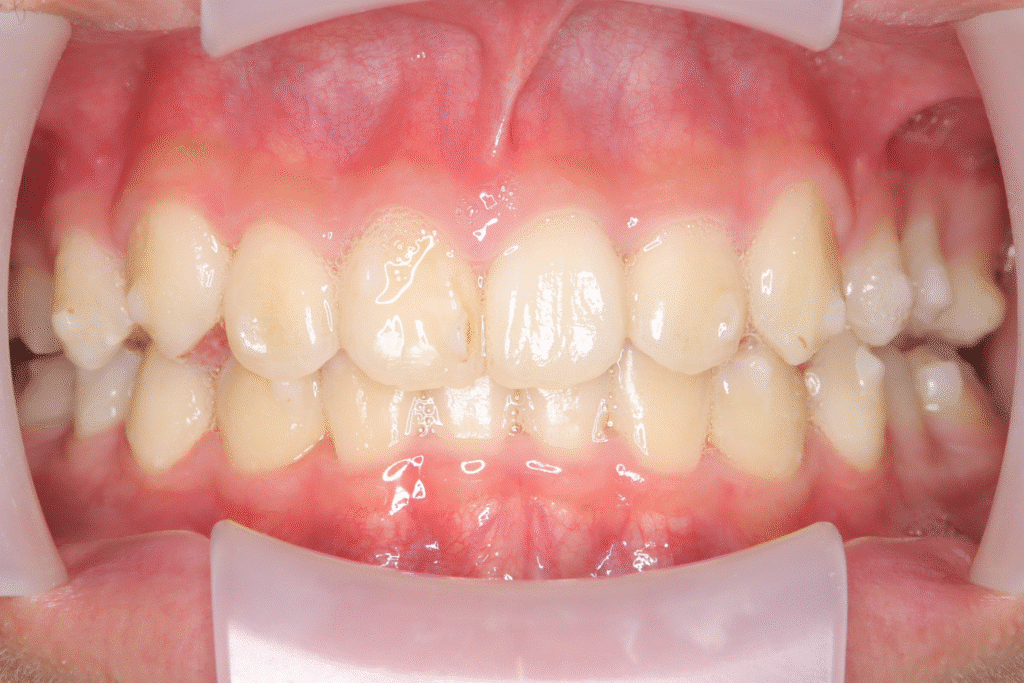 上顎前突(13歳8ヶ月)開始後37ヶ月