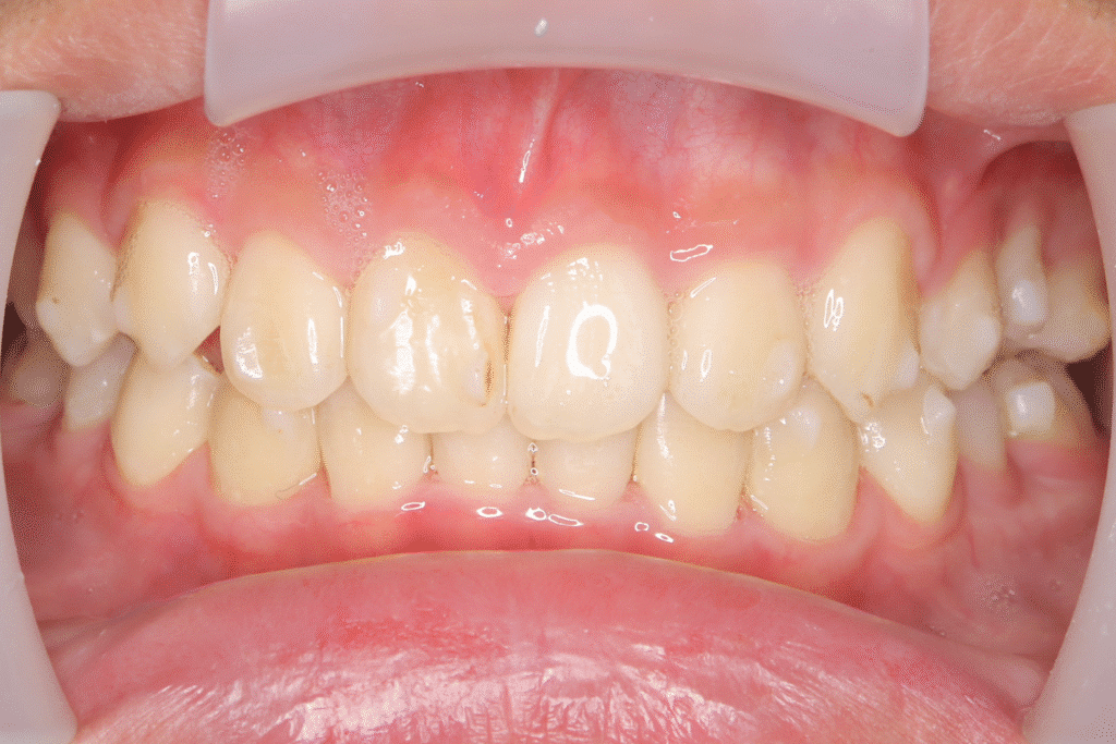 上顎前突(13歳9ヶ月)開始後39ヶ月