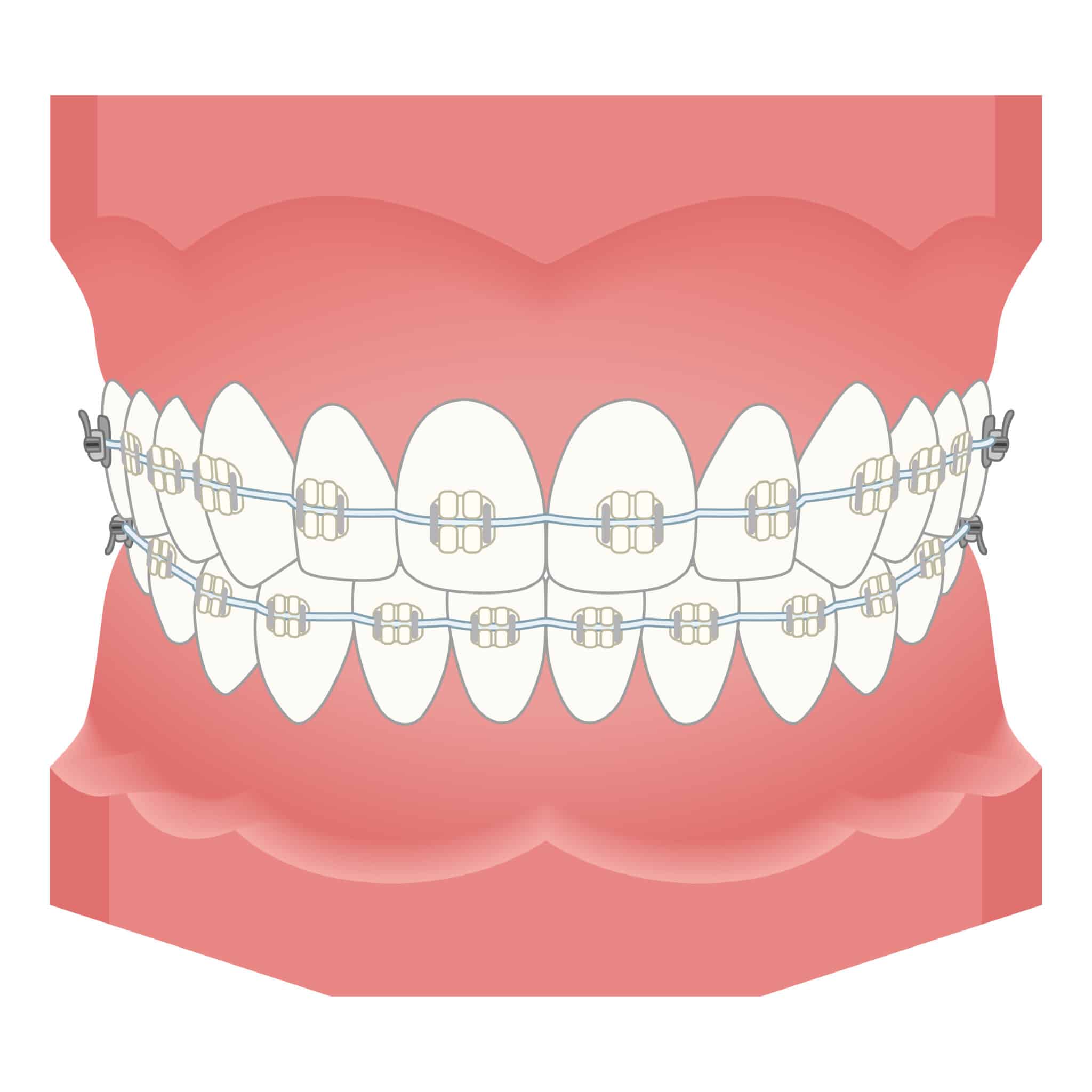 ワイヤー矯正_歯列矯正_矯正器具
