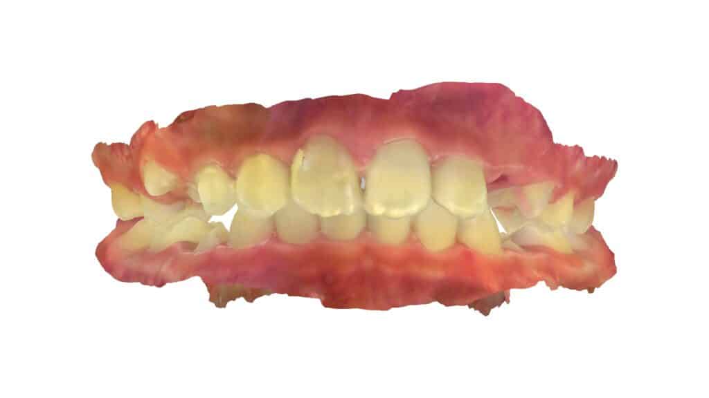 上顎前突(10歳7ヶ月)開始後0ヶ月