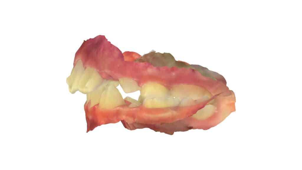 上顎前突(10歳7ヶ月)開始後0ヶ月