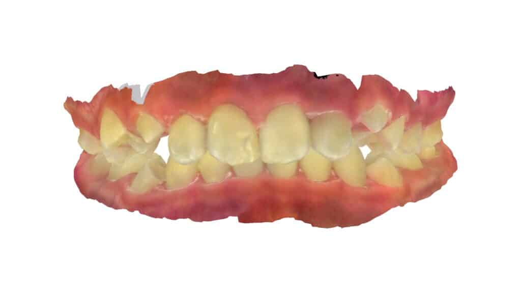 上顎前突(11歳0ヶ月)開始後5ヶ月