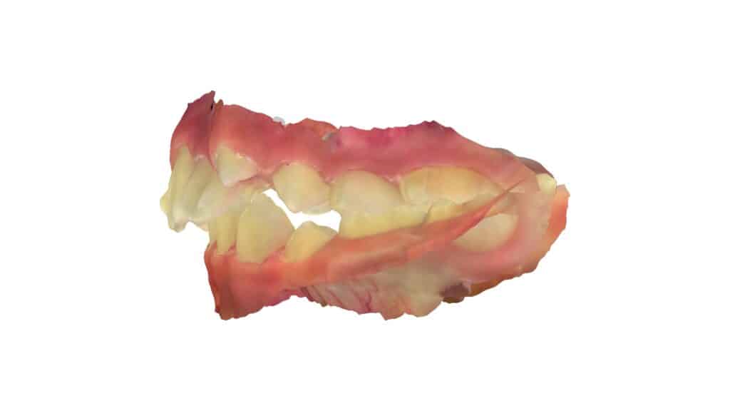 上顎前突(11歳0ヶ月)開始後5ヶ月