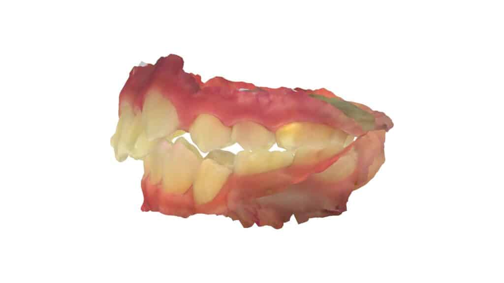 上顎前突(11歳5ヶ月)開始後10ヶ月