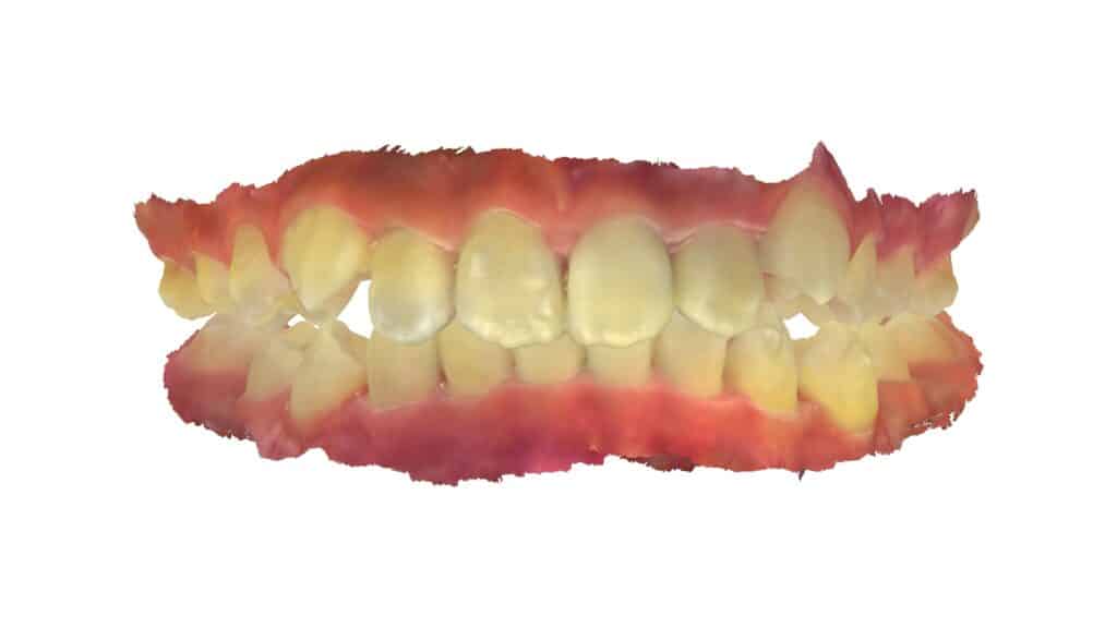 上顎前突(11歳9ヶ月)開始後14ヶ月