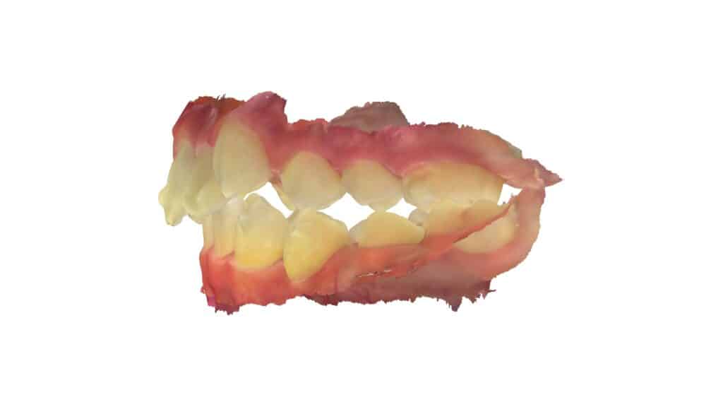 上顎前突(11歳9ヶ月)開始後14ヶ月