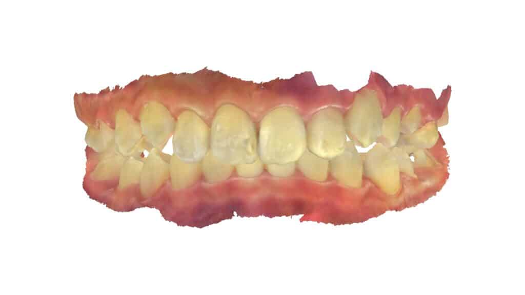 上顎前突(12歳4ヶ月)開始後20ヶ月