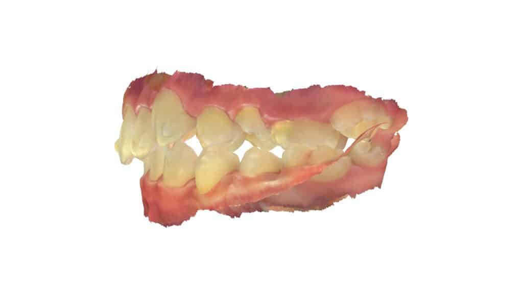 上顎前突(12歳4ヶ月)開始後20ヶ月