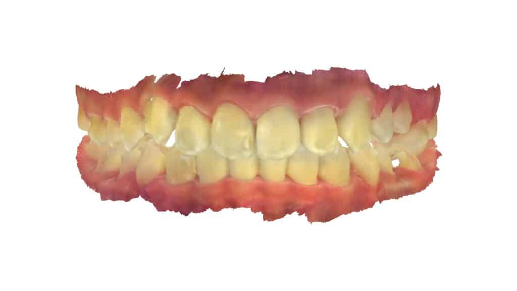 上顎前突(13歳2ヶ月)開始後31ヶ月