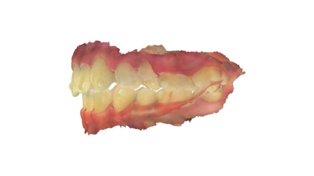 上顎前突(13歳2ヶ月)開始後31ヶ月