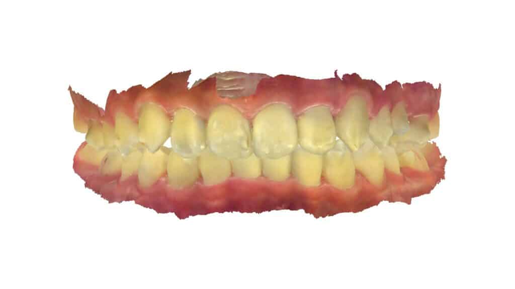上顎前突(13歳9ヶ月)開始後39ヶ月