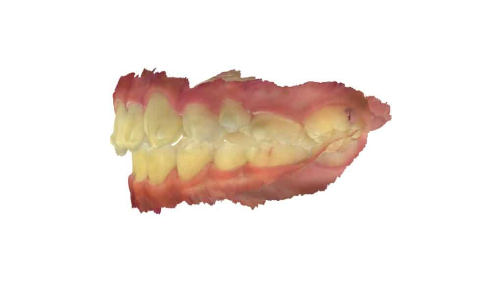 上顎前突(13歳9ヶ月)開始後39ヶ月